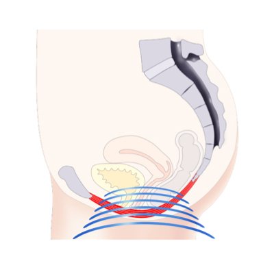 Rejuvenate Your Pelvic Health with Emsella Chair Treatment 